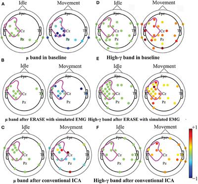 Refinement of High-Gamma EEG Features From TBI Patients With Hemicraniectomy Using an ICA Informed by Simulated Myoelectric Artifacts